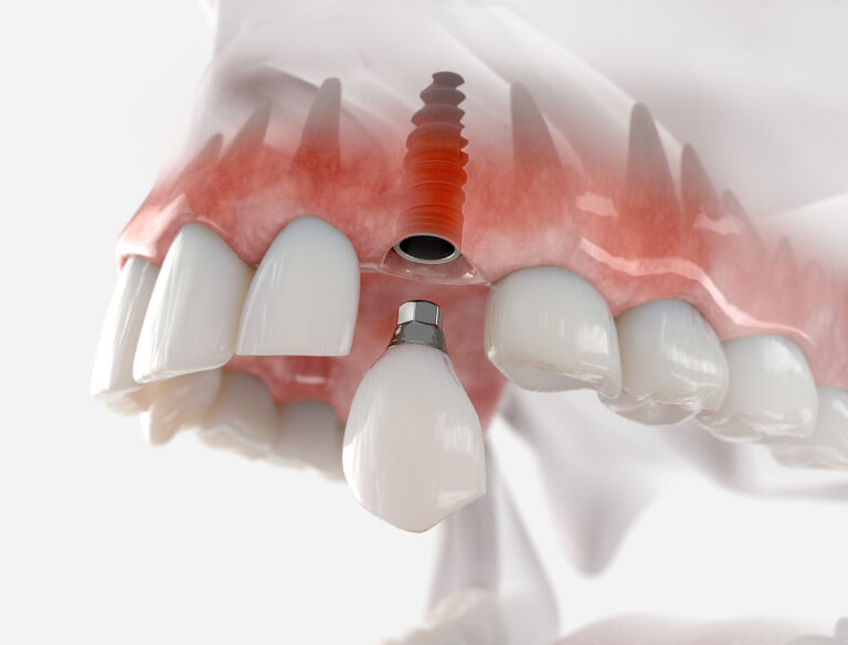 a 3D image of a dental implant.
