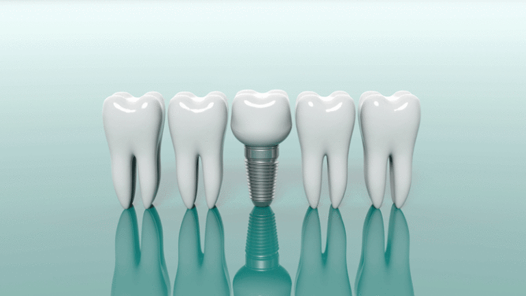 3d model of 4 teeth with a dental implant in the middle of them.