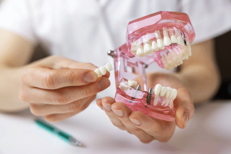 dentist implantologist showing dental bridge implant technology on human tooth jaw model.